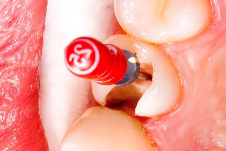 Endodoncja